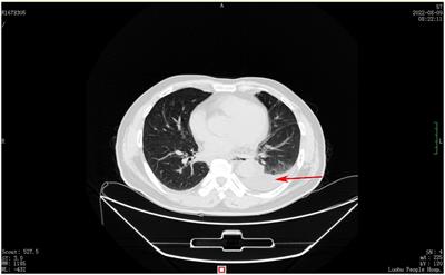 The perilous consequences of bowel preparation: a case study with literature review of Boerhaave syndrome